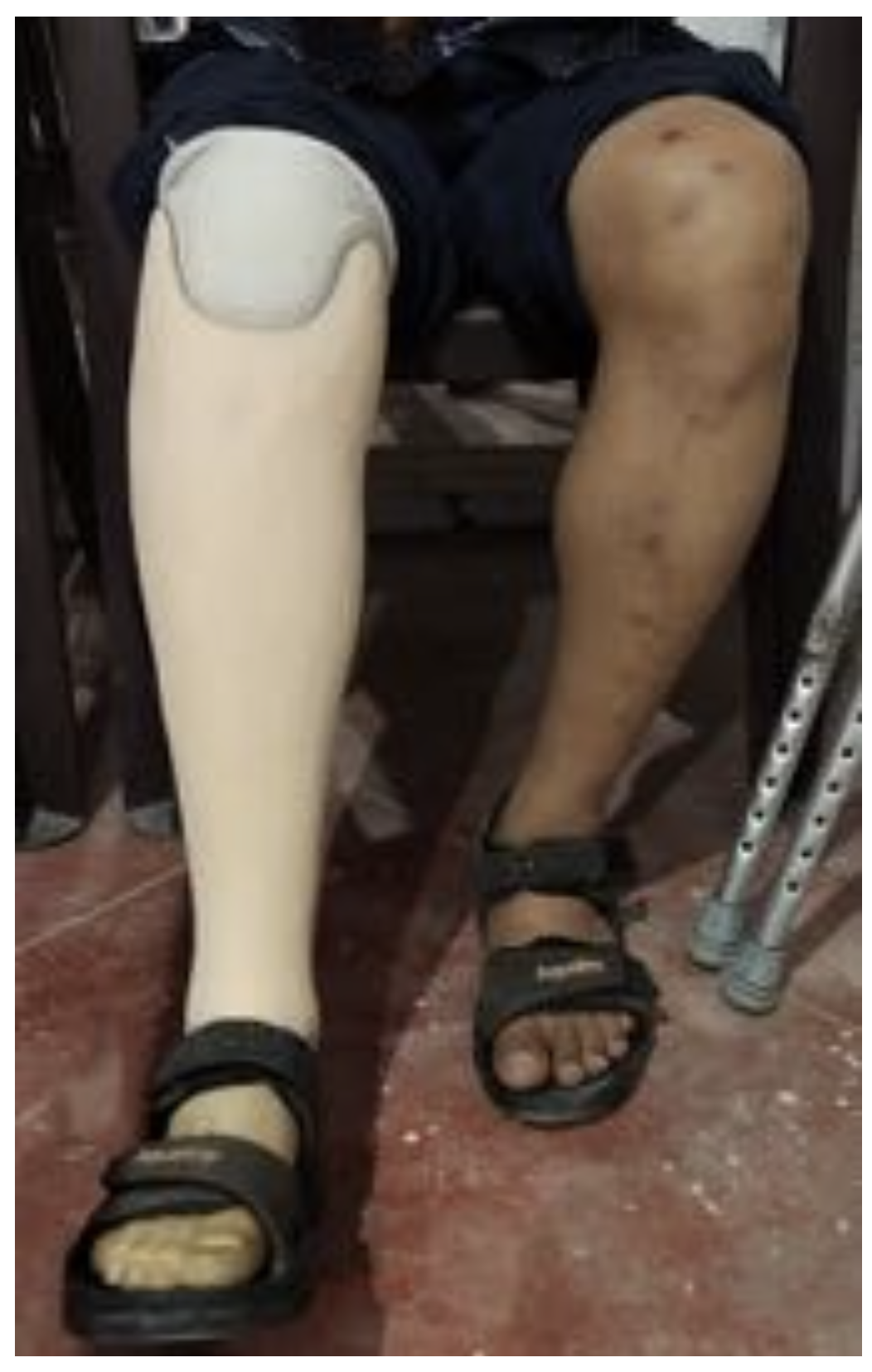 Lower leg prosthesis